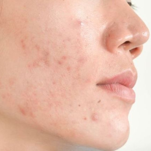 Tallow Skincare for Acne-Prone Skin